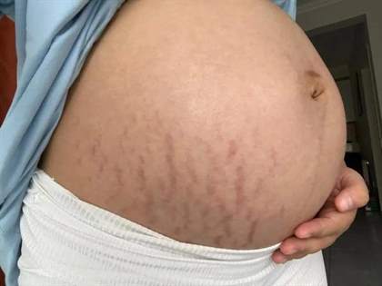 消除妊娩纹：实际恢复时间与有效方法揭秘