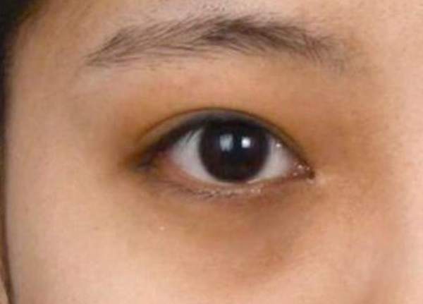 黑眼圈重原因及最快消除方法